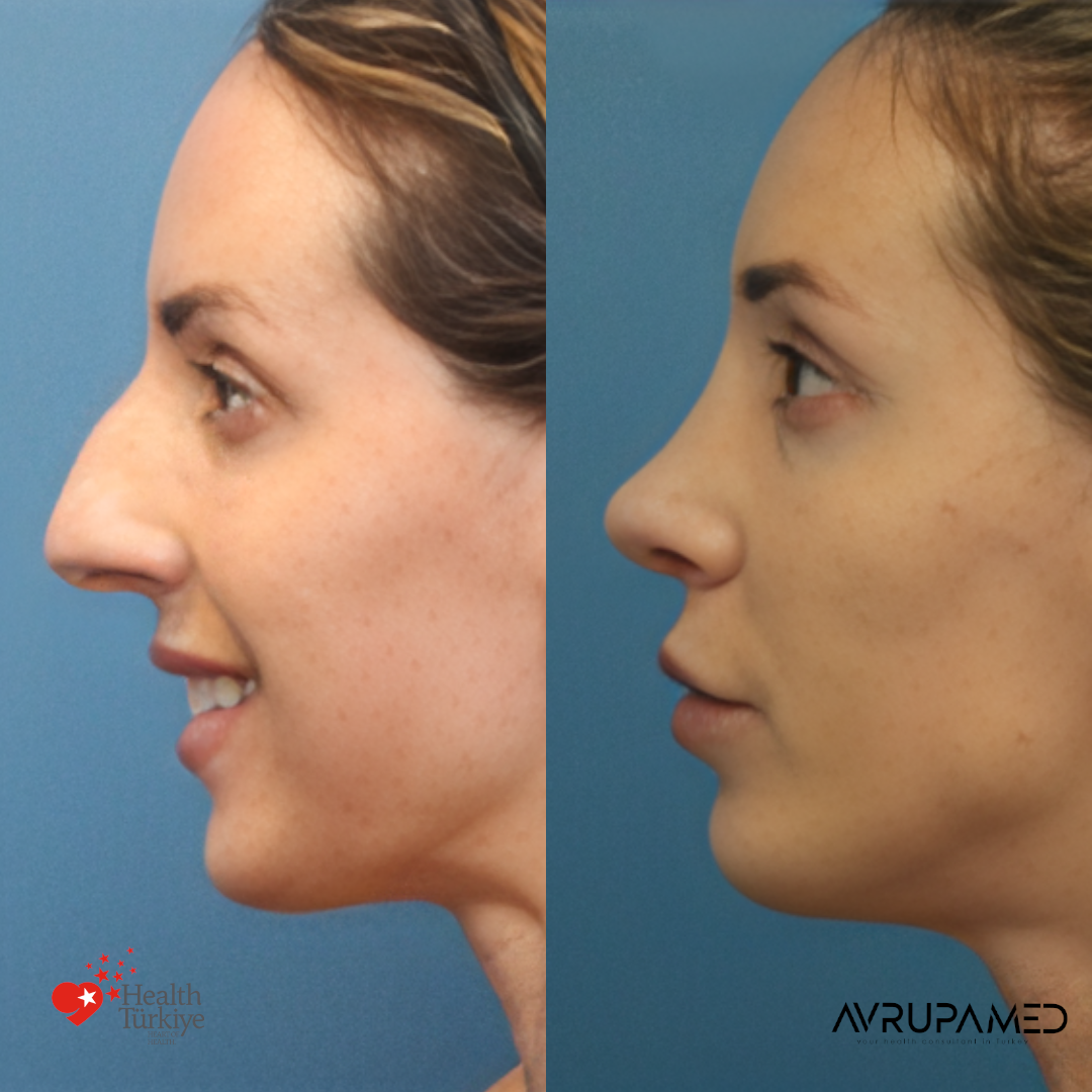 Rhinoplasty 33 Rhino 1
