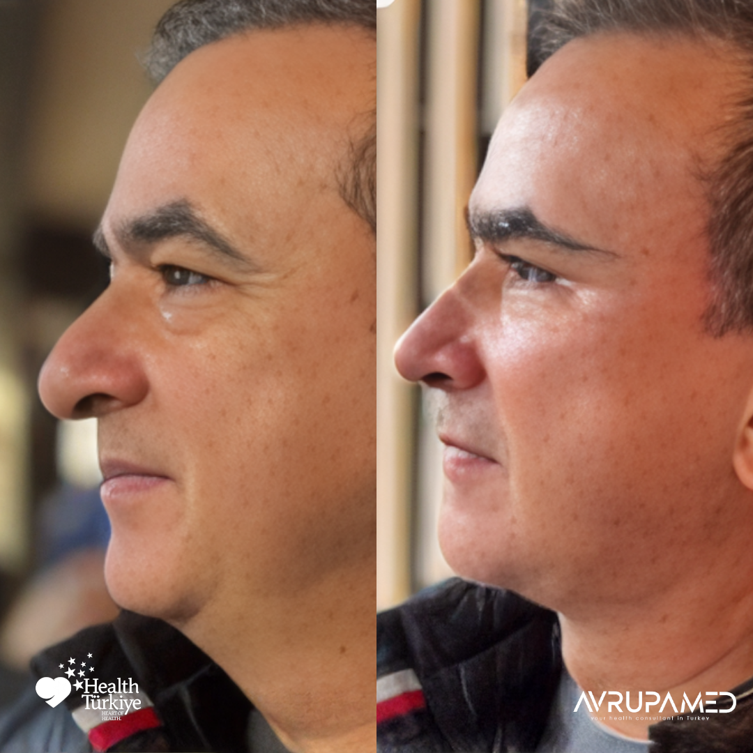 Rhinoplasty 34 Rhino 2