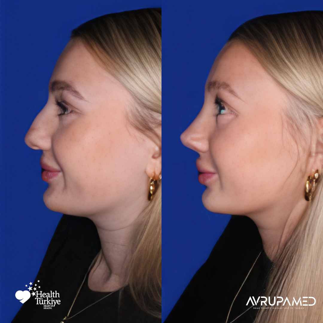 Rhinoplasty 35 Rhino 3