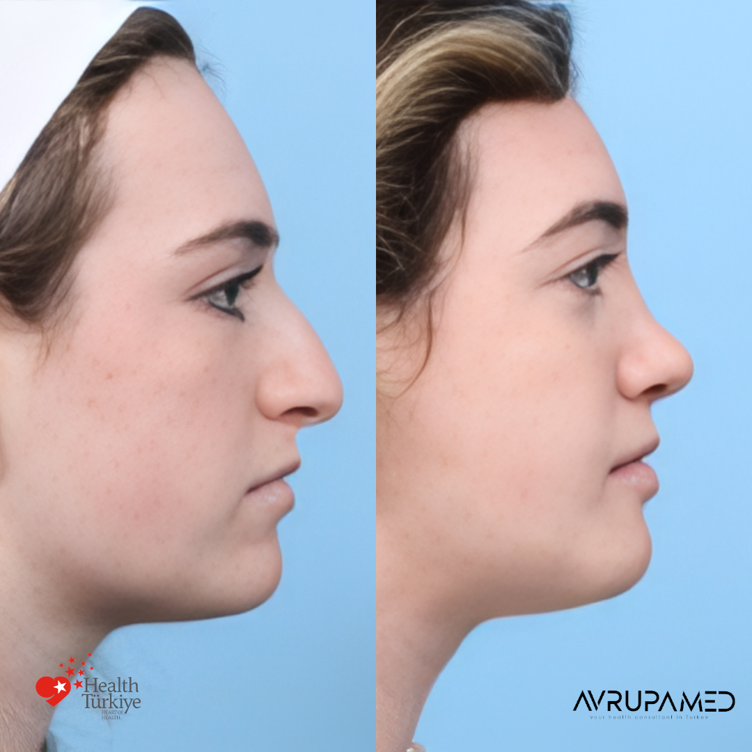 Rhinoplasty 37 Rhino 5