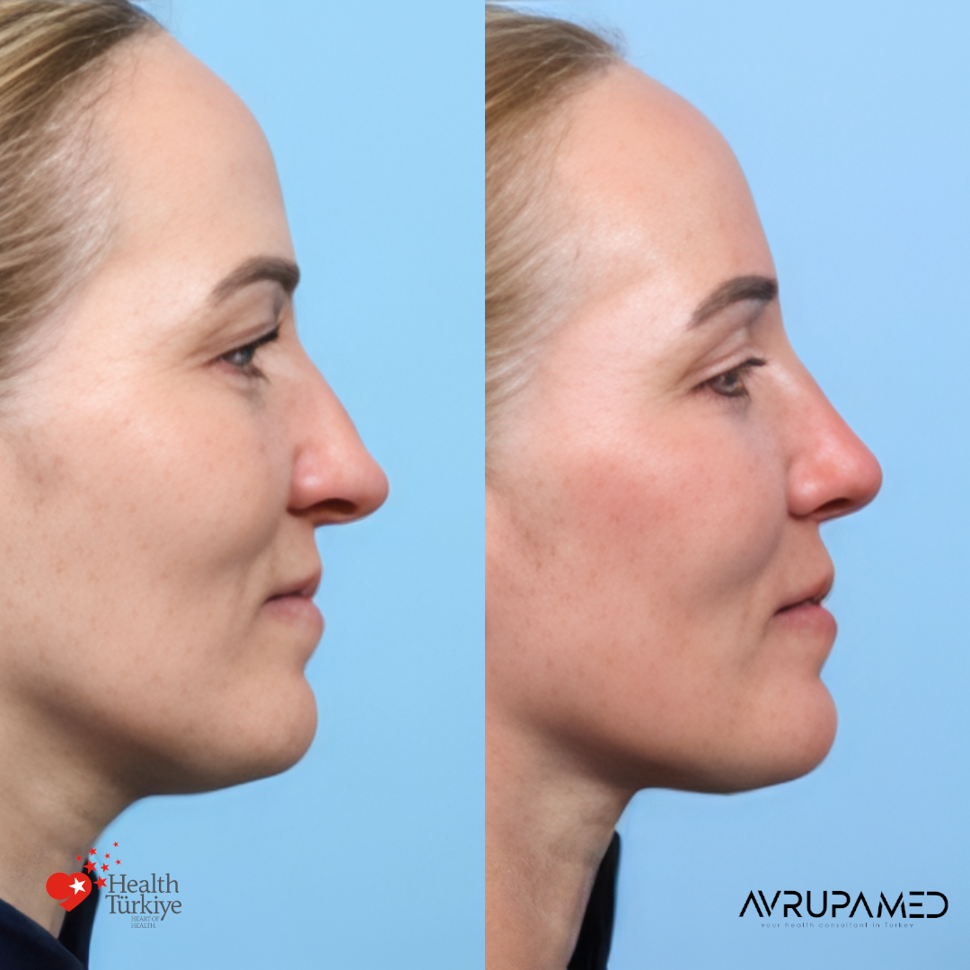 Rhinoplasty 38 Rhino 6